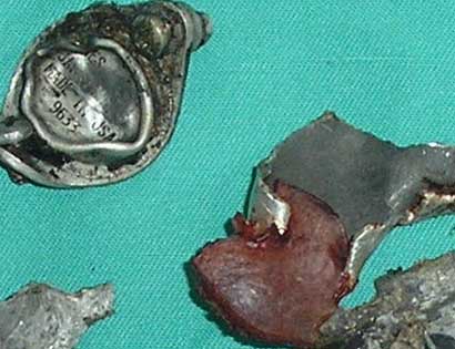 Les médecins ont retiré du corps d'un Palestinien un morceau de métal estampillé 'USA'